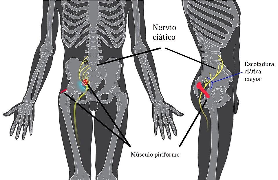 File:Piriformis syndrome-es.jpg