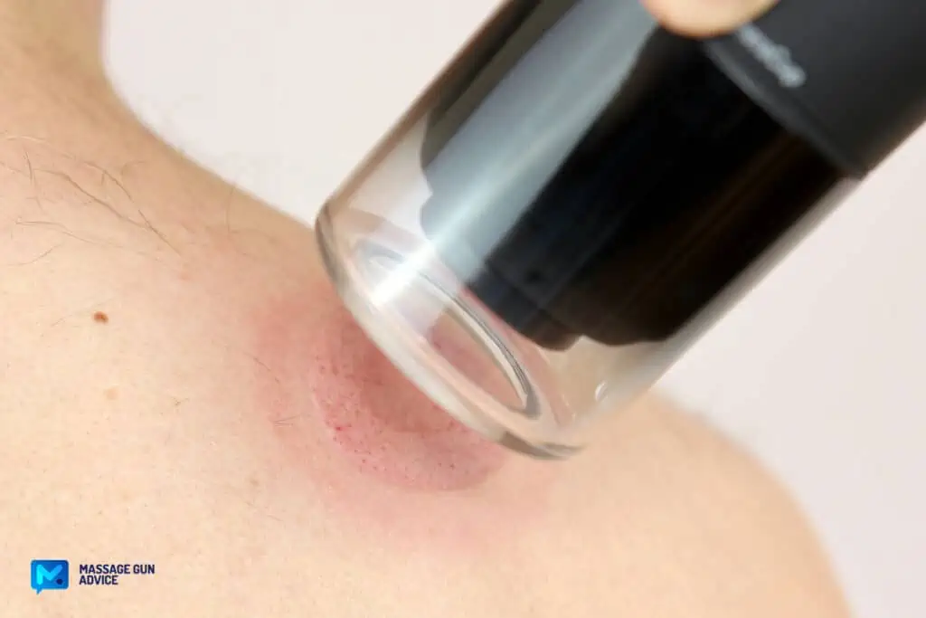 What Toxins Are Released After Massage? Demystifying Detoxification 5 cupping therapy toxins: Effect on a shoulder